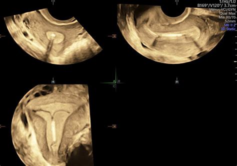 Échographie Pelvienne de contrôle de dispositifs intra utérins