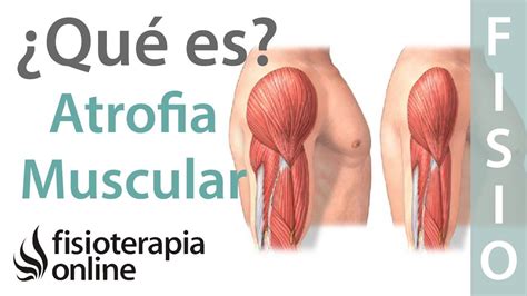 Atrofia muscular Qué es y cómo sucede Atrofia muscular Manguito