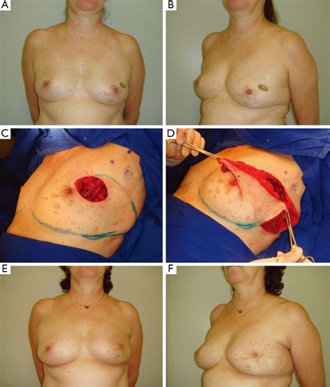 Oncoplastic Breast Surgery Indications Techniques And Perspectives Pmc