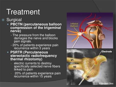 Trigeminal Neuralgia