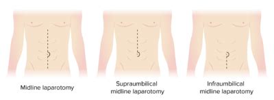 Laparotomy Meaning