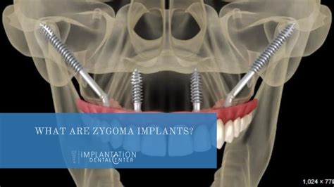 What Are Zygoma Implants Implantation Dental Center