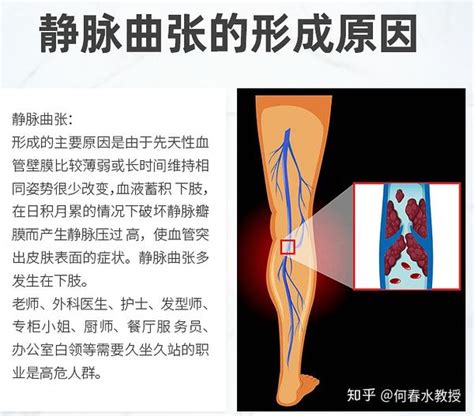 下肢静脉曲张 患者指南 知乎