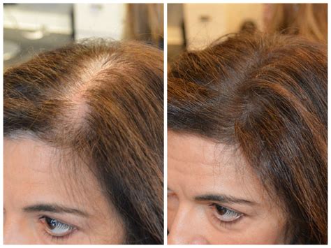 Hair Loss In Women What Every Woman Should Know