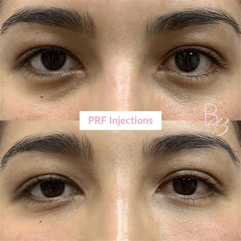 Eyes Make You Look Older Try PRF Under Eye Treatments