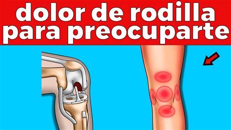 Tipos De Dolores De Rodilla Alarmantes Que Debes Conocer Youtube