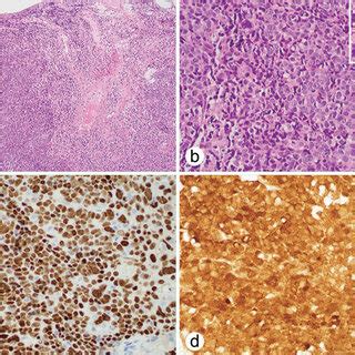 Oropharyngeal squamous cell carcinoma. (a, b) Biopsy of the base of the ...