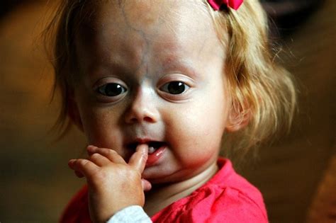 Progeria Infant