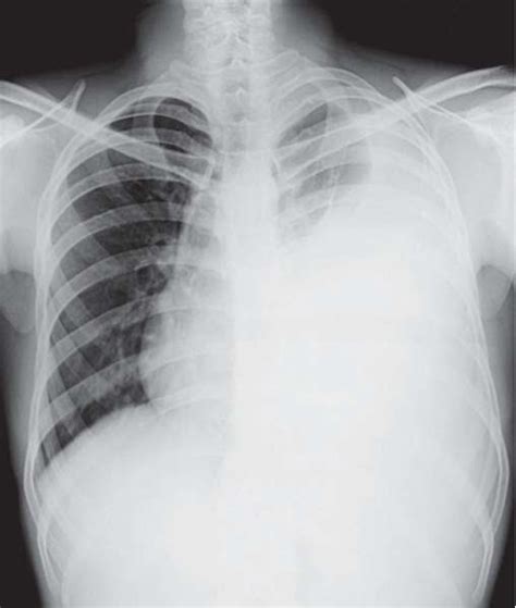 Study Medical Photos Pleural Effusion On Chest X Ray