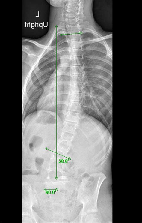 Weight Bearing Anteroposterior Full Spine Scoliosis Radiograph Showing