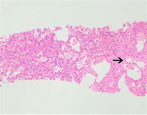 Pathology Outlines Hemangioma