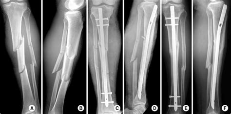 (A, B) Preoperative radiographs of a 56-year-old man show a tibia ...