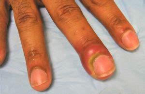 Hangnail Infected Hangnail Causes Symptoms Diagnosis Treatment