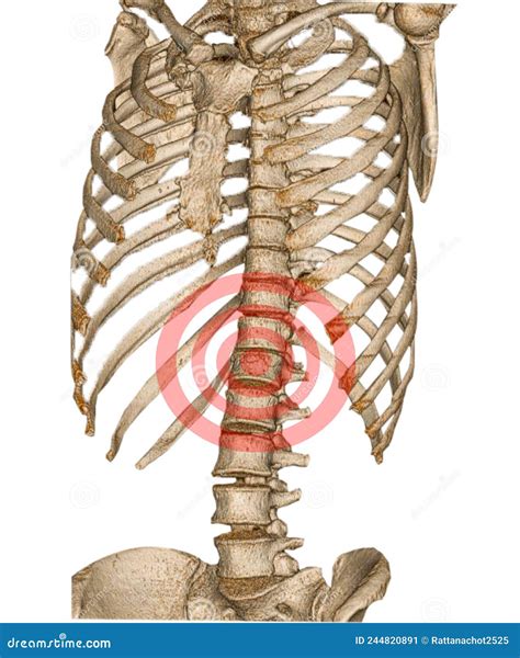 Spine Scan With 3d Reconstruction The Film Showing Thoracolumbar