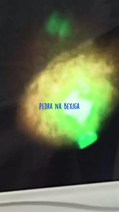 Pedra Na Bexiga Bexiga Pedras