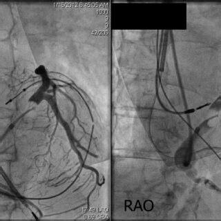 Fluoroscopy With Left Anterior Oblique And Right Anterior Oblique Views