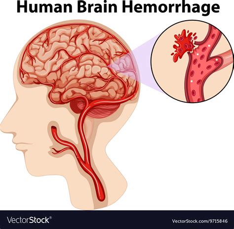 Diagram Of Human Brain Hemorrhage Royalty Free Vector Image