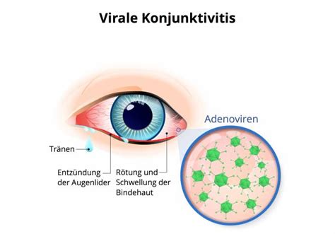 Bindehautentz Ndung Ursache Symptome Behandlung