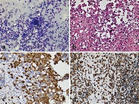 Malignant Histiocytosis A Inflammatory Cells Large Histiocytes And