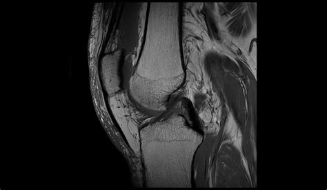 Baker's cyst rupture MRI | Radiology Article on Baker cyst rupture