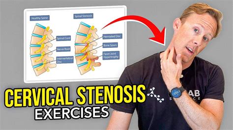 5 Exercises for Cervical Stenosis (Arm Nerve Pain) | Nerve pain ...