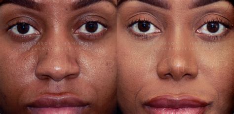 African American Nose Shapes