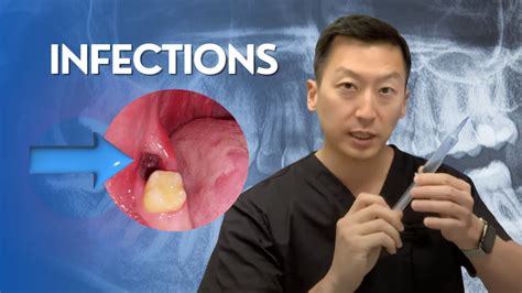 Infections After Wisdom Teeth Removal Youtube