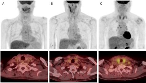 Petct Scans Predict Low Thyroid Function In Radiotherapy Patients