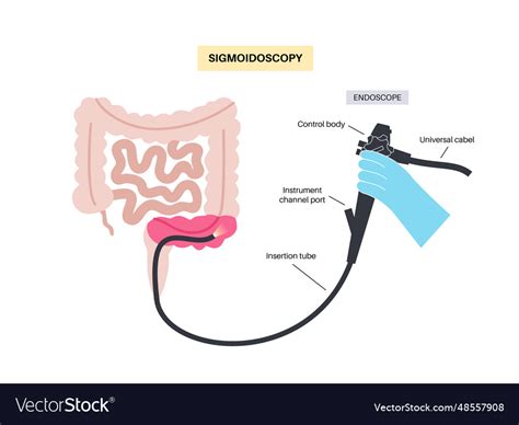 Sigmoidoscopy medical procedure Royalty Free Vector Image