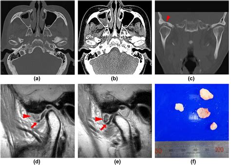 Imaging Features Of Synovial Chondromatosis Of The Temporomandibular