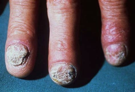 Fingernail and Toenail Abnormalities: Nail the Diagnosis