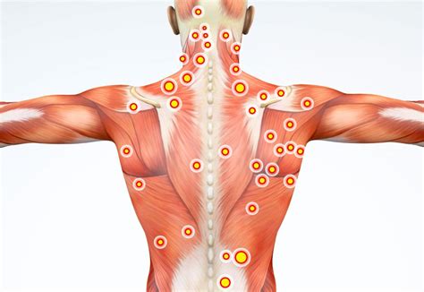 Trigger Point Massage Therapy For Pain Relief Swedish Institute