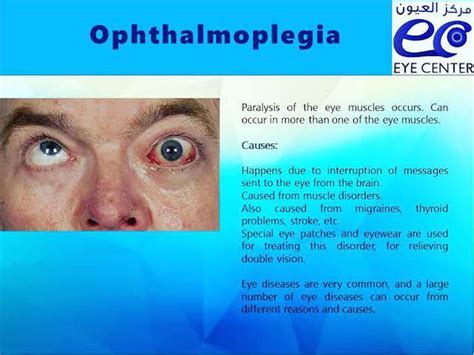 Opthalmoplegia Medizzy