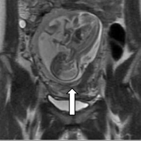 T 2 Weighted Sagittal MRI Image Showed Compressed Lower Uterine Segment