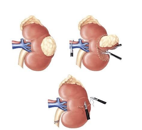 Tumor Renal Hospital Amaral Carvalho Urologia Jaú