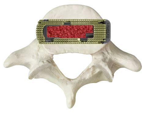 Lateral Lumbar Interbody Fusion Surgery Globus Medical