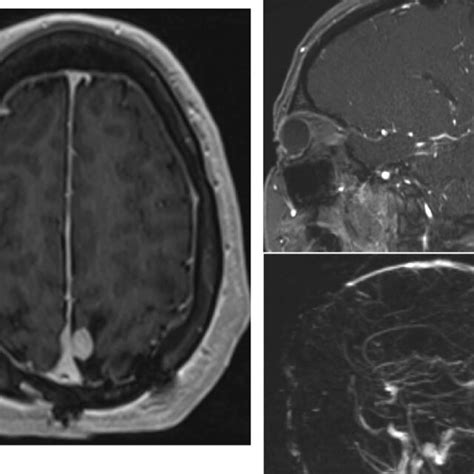 Meningiomas Arise From Meningothelial And Arachnoid Cap Cells Of The