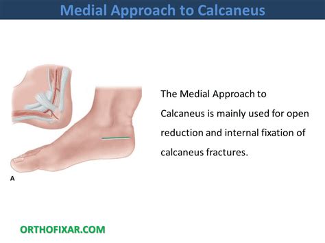 Medial Approach To Calcaneus • Full Tutorial • 2025