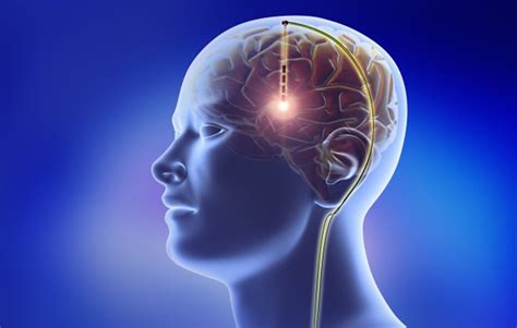 Consult Best Brain Surgeon Dr Dhakoji For You In Pune