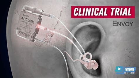 Fully Implanted Acclaim Cochlear Implant Clinical Trial Interview With