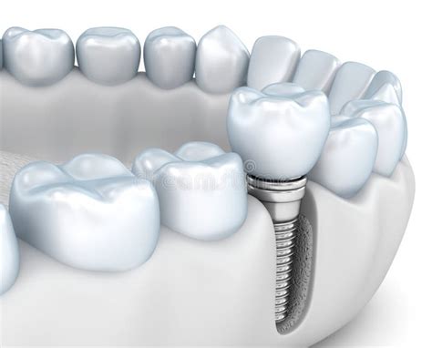 Tooth Human Implant Dental Concept Human Teeth Or Dentures Stock