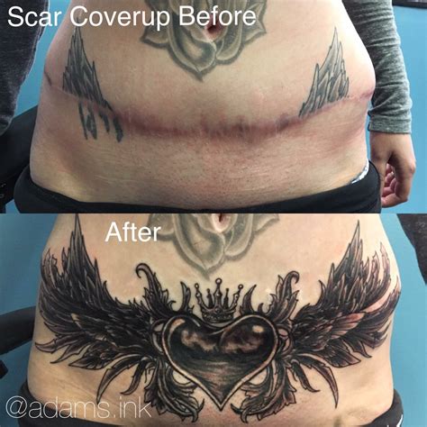 Tummy Tuck Scar Coverup Scar Tattoo Cover Up Tattoos Tummy Tuck Scar Tattoo