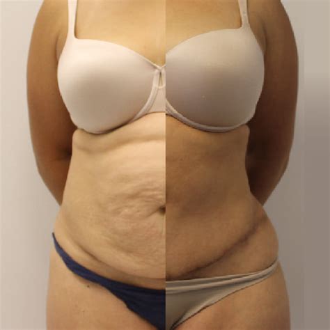 Patiente Chirurgie Plastique Montr Al