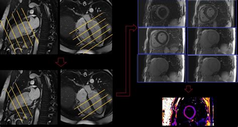 Mri Cardiac T1 Mapping T2 Mapping And T2 Mapping