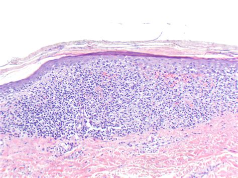 VIRTUAL GRAND ROUNDS IN DERMATOLOGY 2.0: Mycosis Fungoides