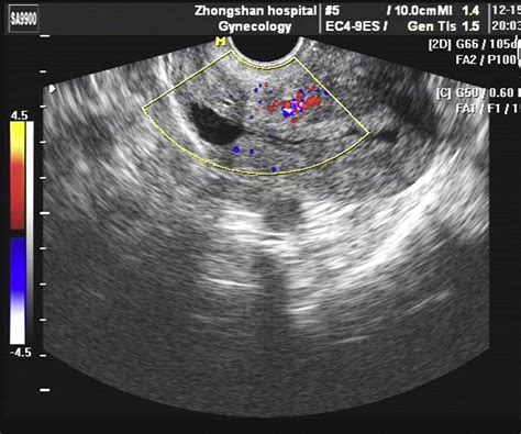 Vaginal Repair Of Cesarean Section Scar Diverticula Journal Of