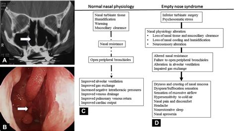 Empty Nose Syndrome And Atrophic Rhinitis Annals Of Allergy Asthma And Immunology