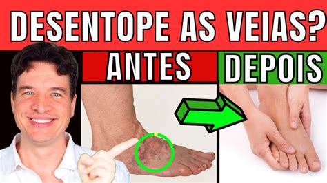 7 DICAS NATURAIS De Se Livrar Das VEIAS ENTUPIDAS E Aumentar O Fluxo