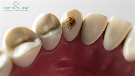 Do You Have Tooth Decay 5 Signs You Need To See A Dentist