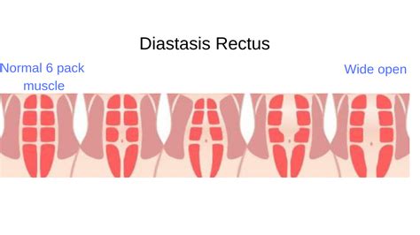 Diastasis Rectus Abdominis Or Abdominal Separation